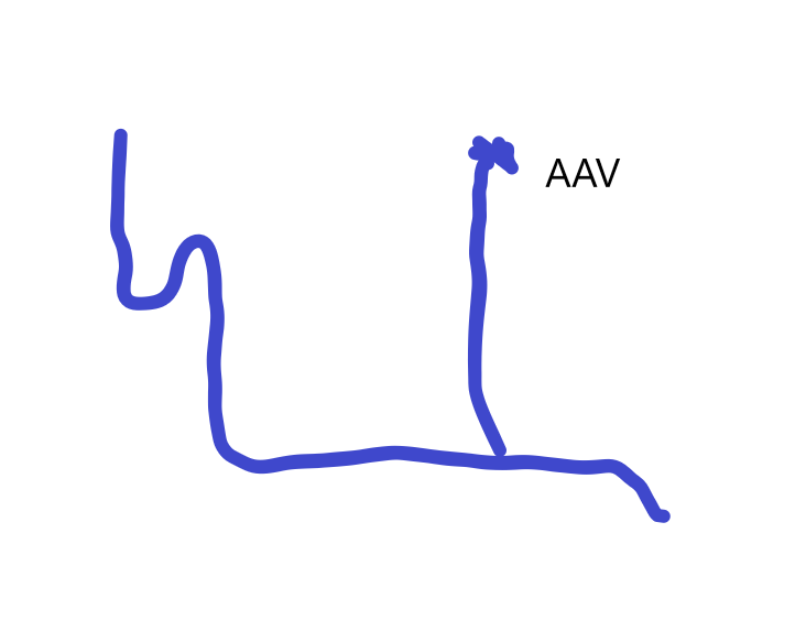S bend AAV position.png